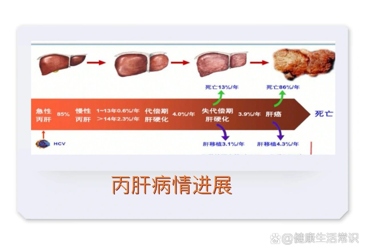 丙肝的潜伏期多长?