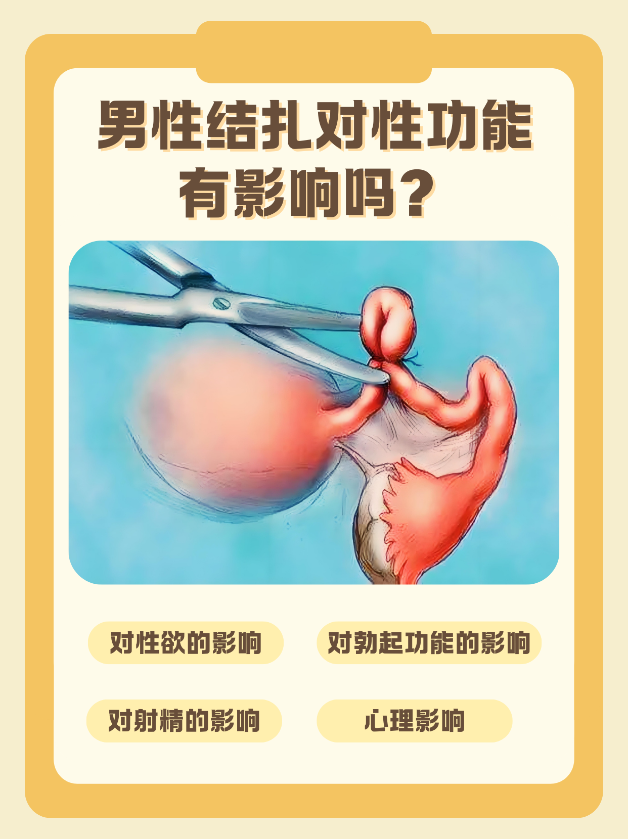 男性结扎好还是女性结扎好?