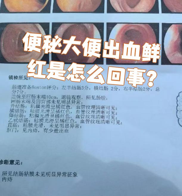 每次大便都出血,去年还没有痔疮的,图片