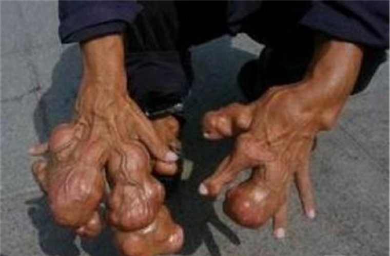 骨癌的临床症状有哪些