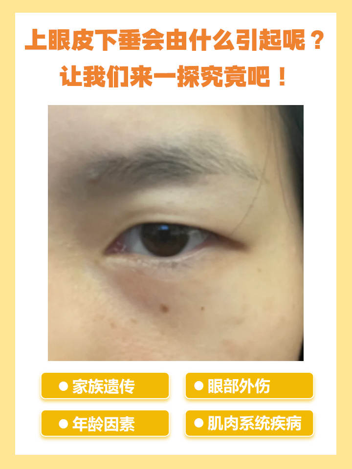 上眼睑下垂是什么原因?