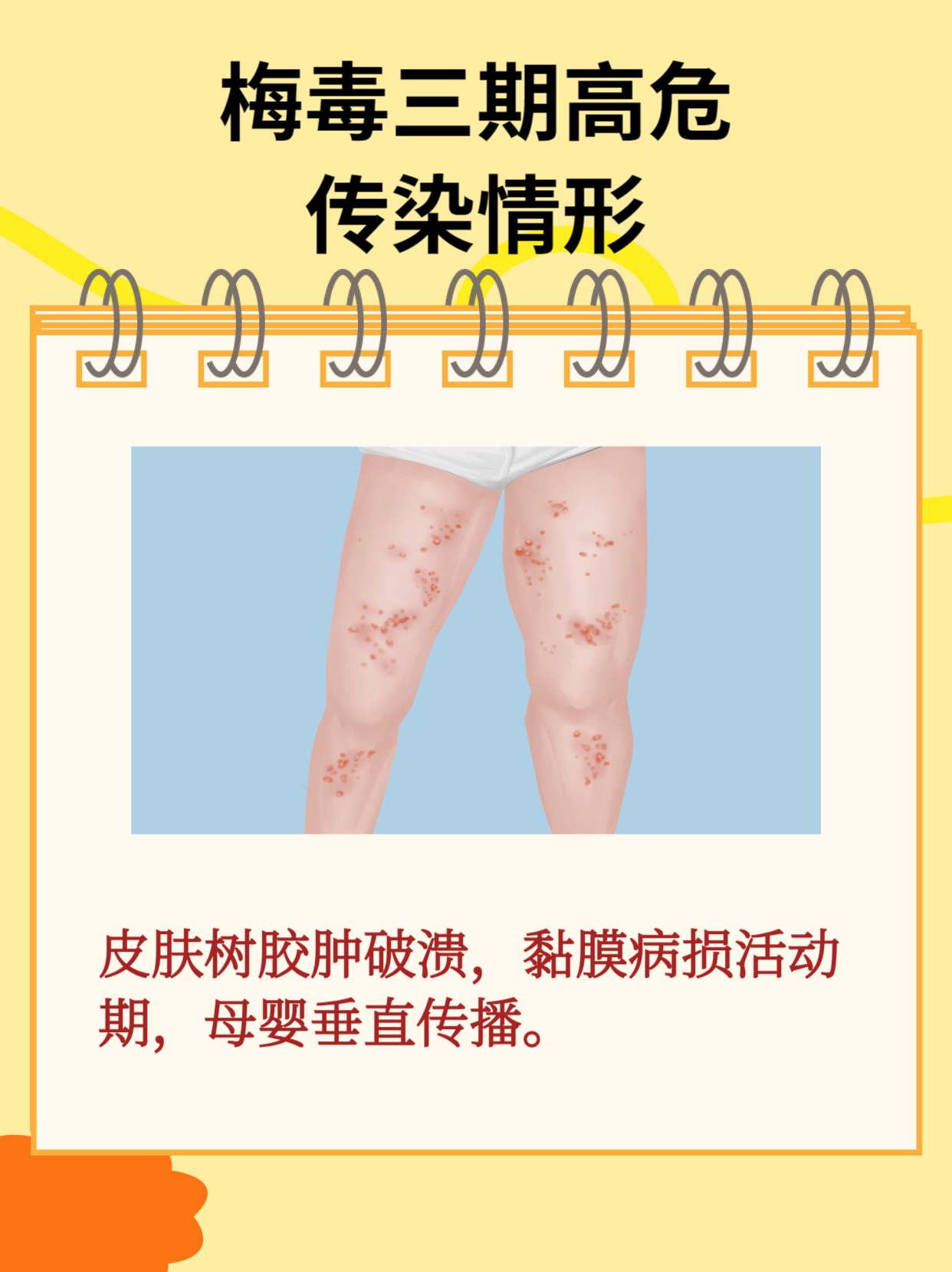 梅毒会传染人吗