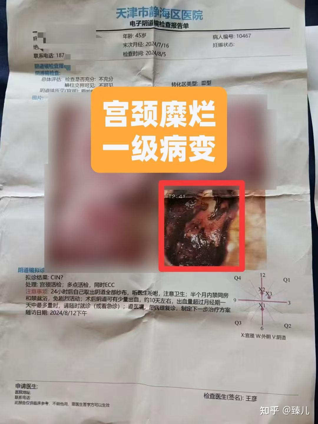 宫颈糜烂一度怎么办