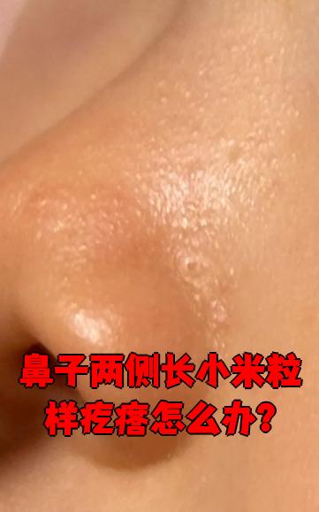 鼻翼长痘痘怎么回事怎么办