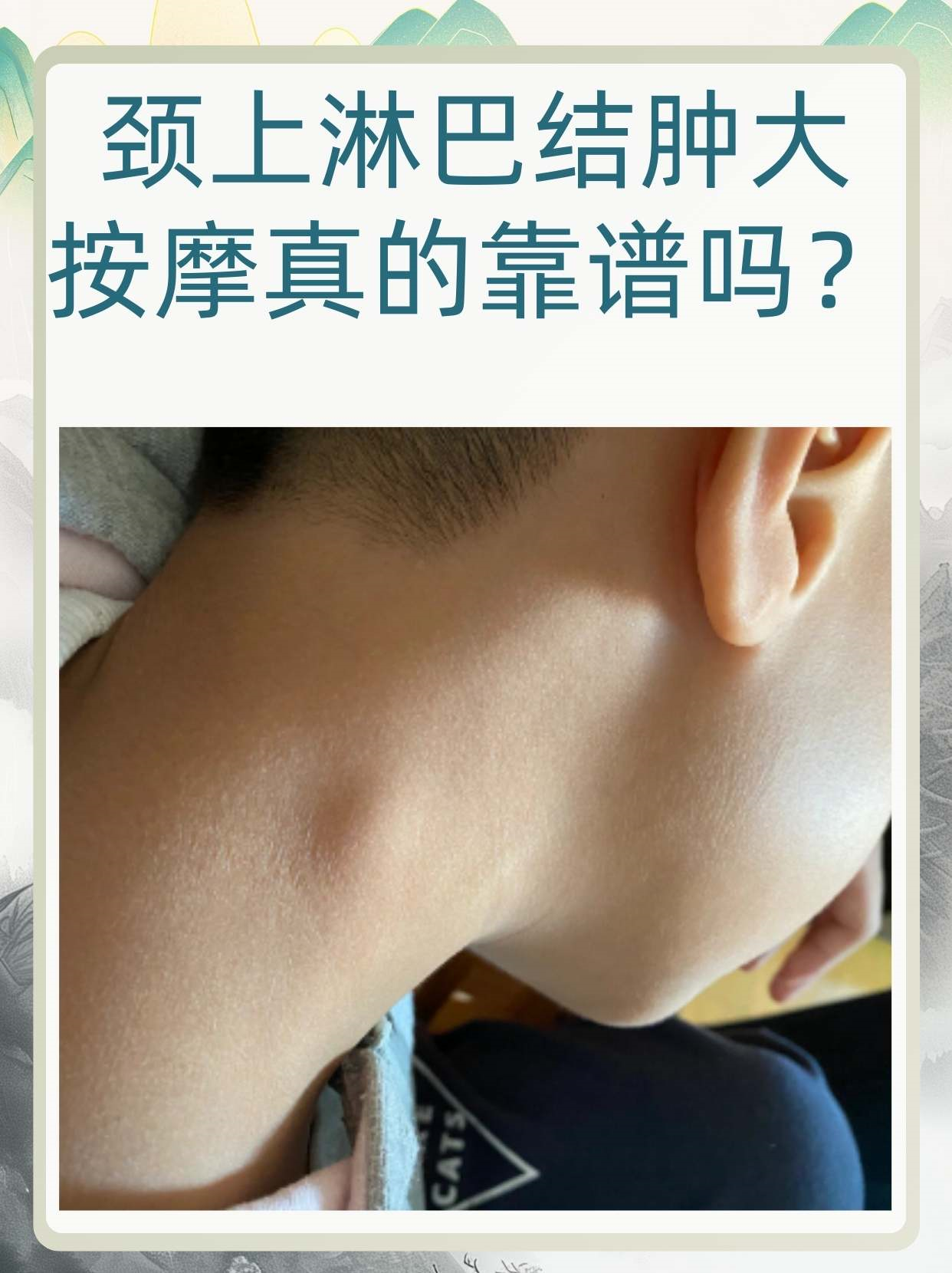 颈部淋巴结炎的症状有哪些