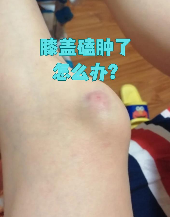骑自行车摔了一跤,膝盖肿疼,怎么处理