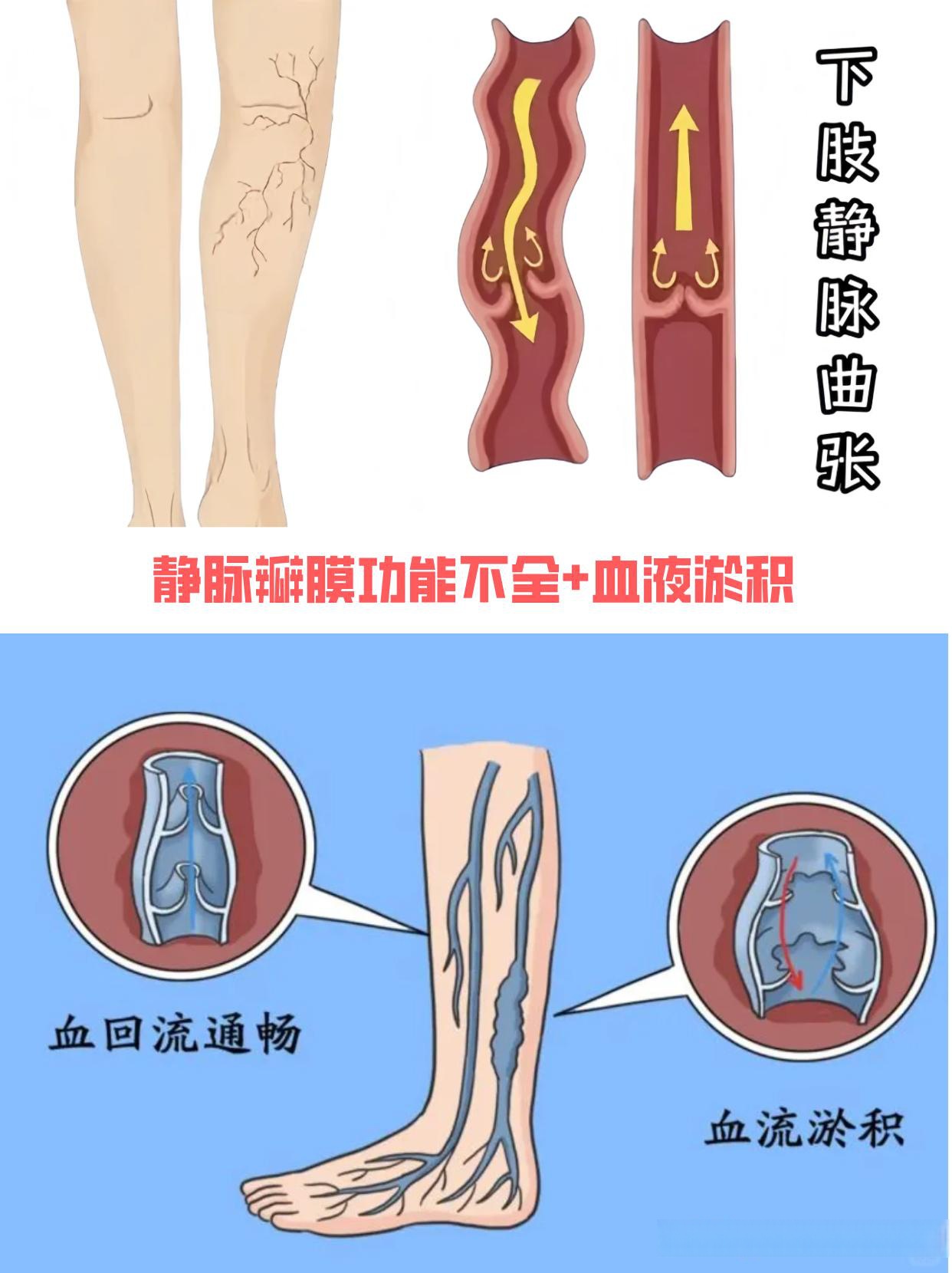 静脉曲张与脉管炎有区别吗