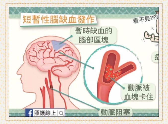 脑供血不足的症状