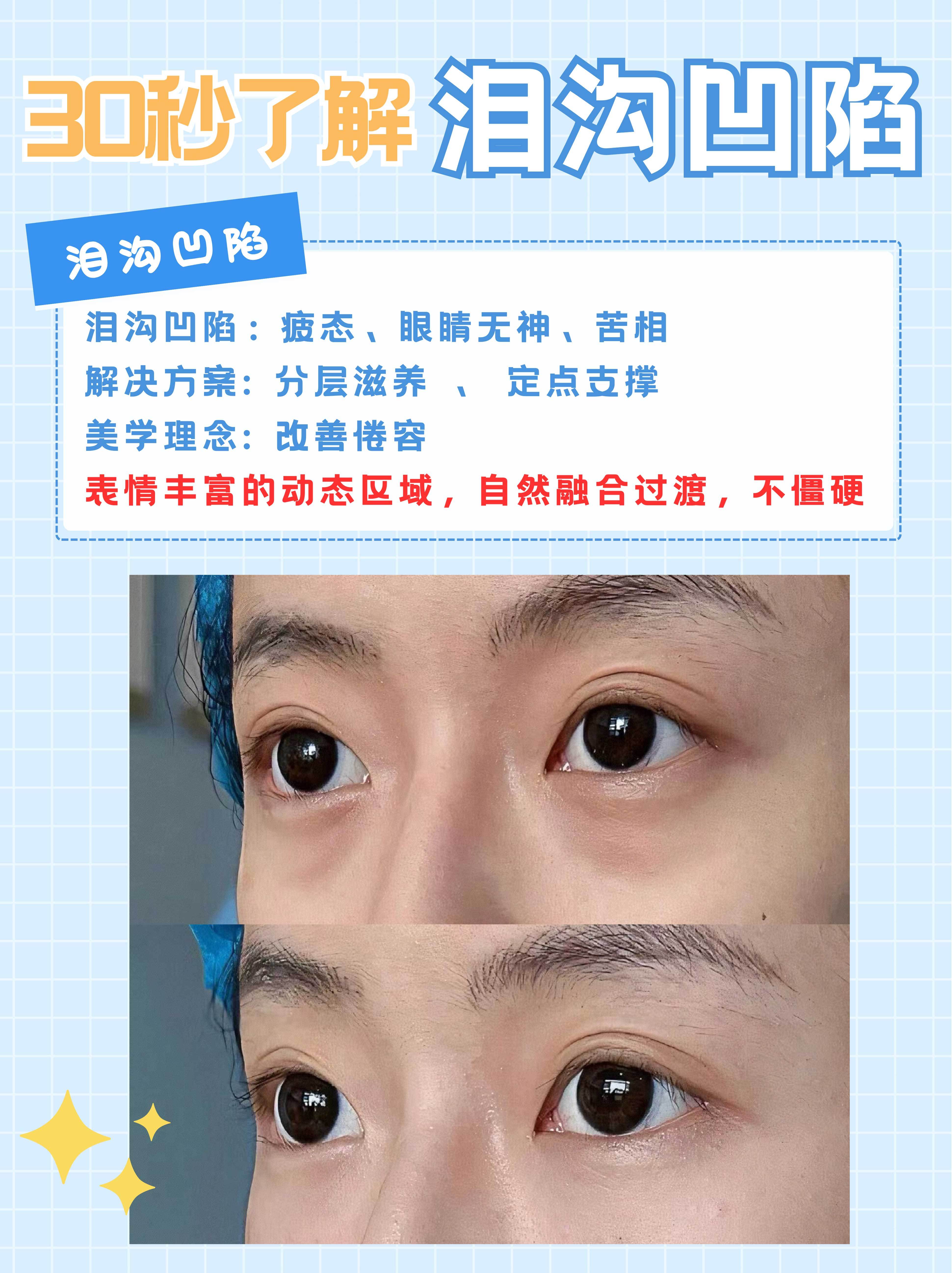 眼睛凹陷是什麽原因