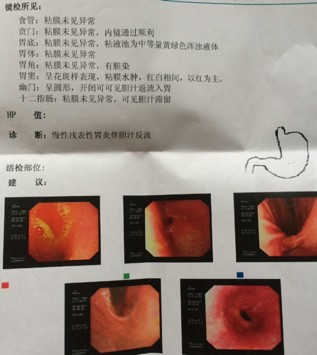 慢性浅表性胃炎.的症状