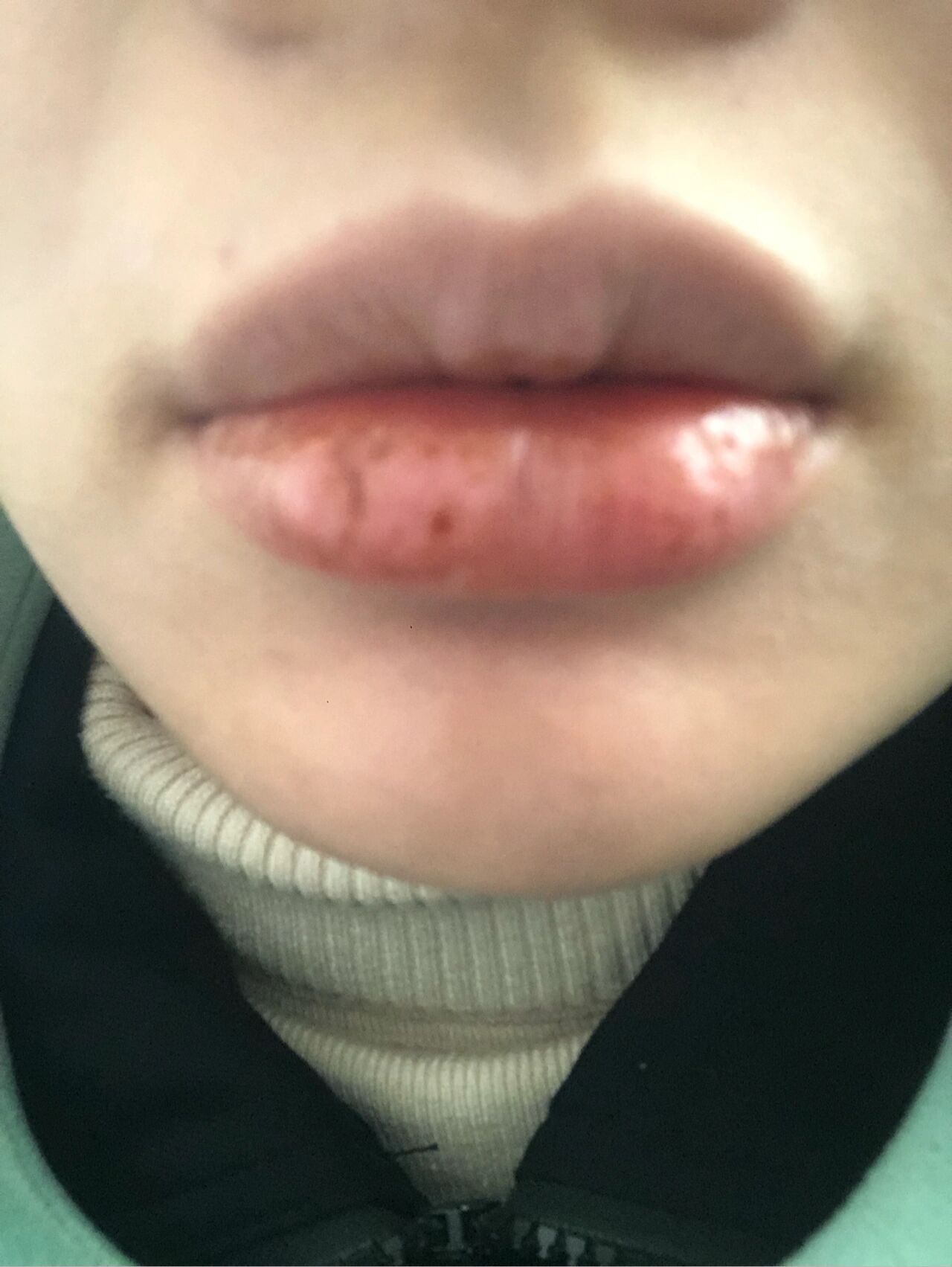 嘴皮肿了是怎么回事