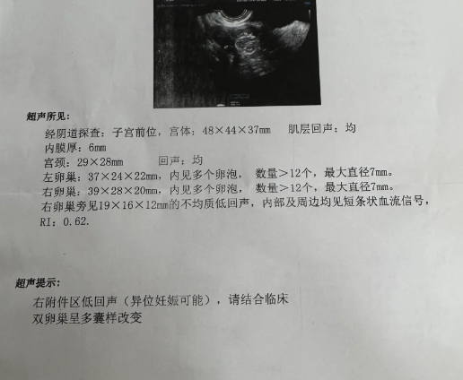 宫外孕一般多长时间可以发现