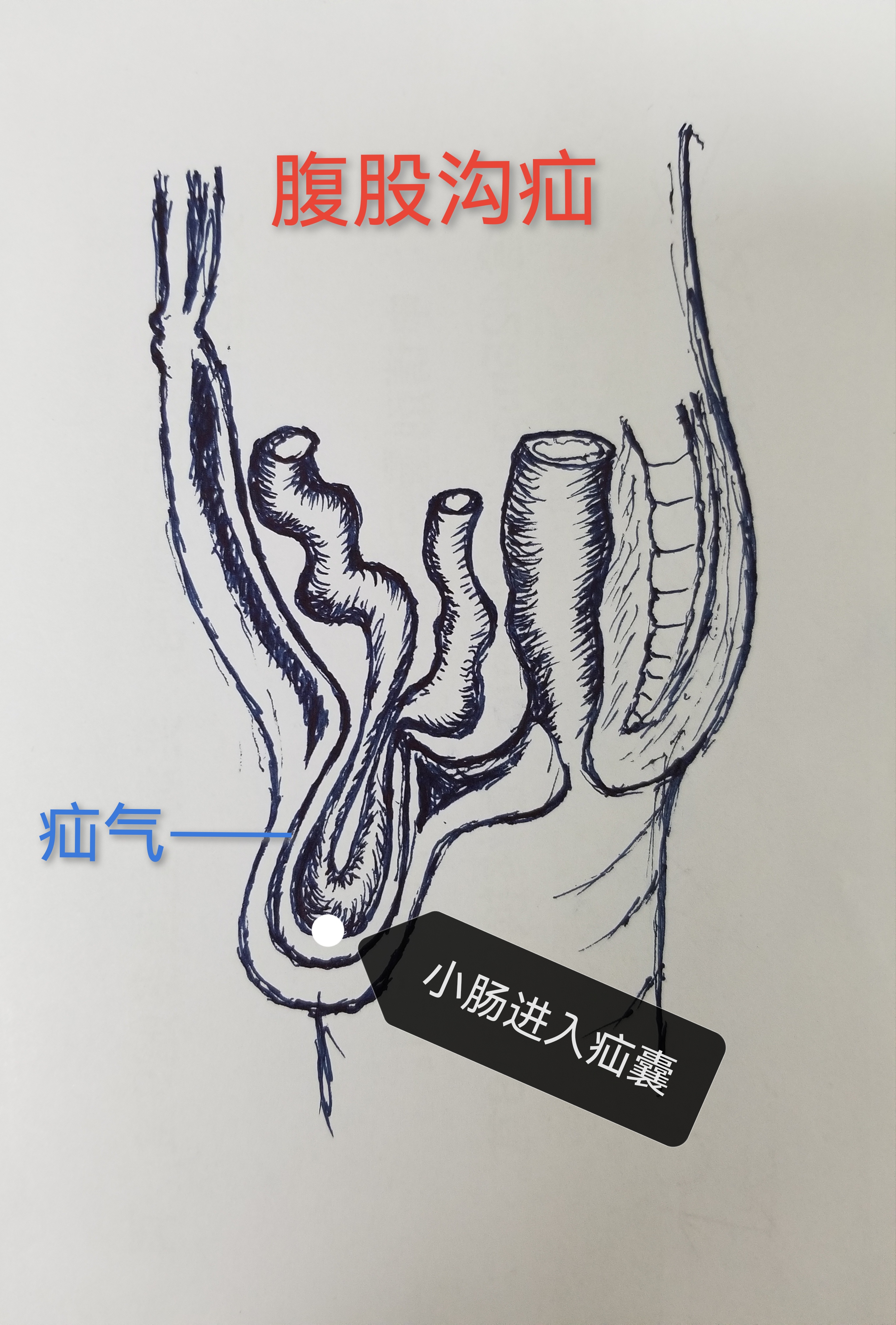 腹股沟斜疝怎么治疗