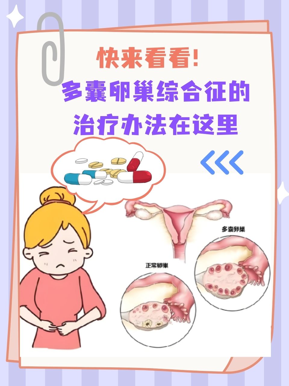 多囊卵巢综合征什么表现症状