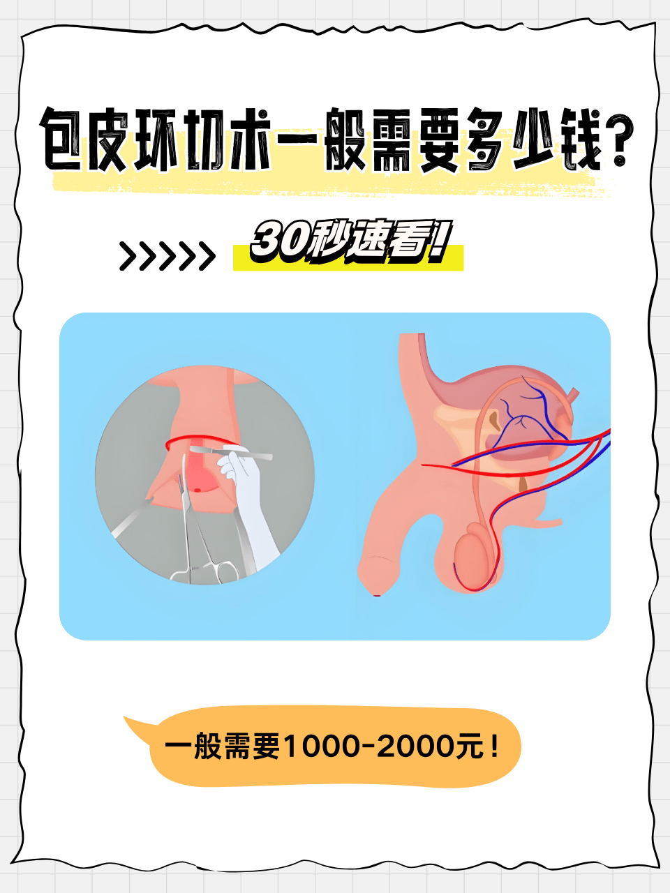 韩式环切包皮手术