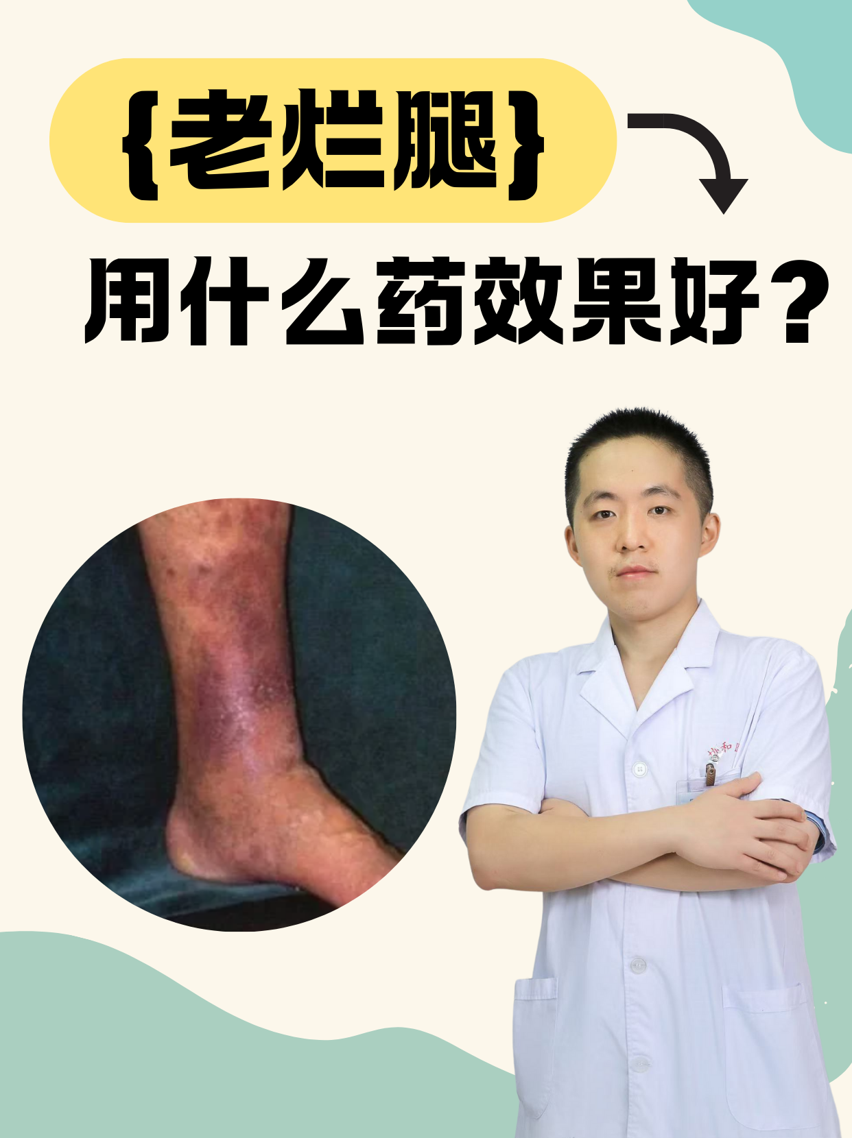 下肢静脉炎怎么回事啊
