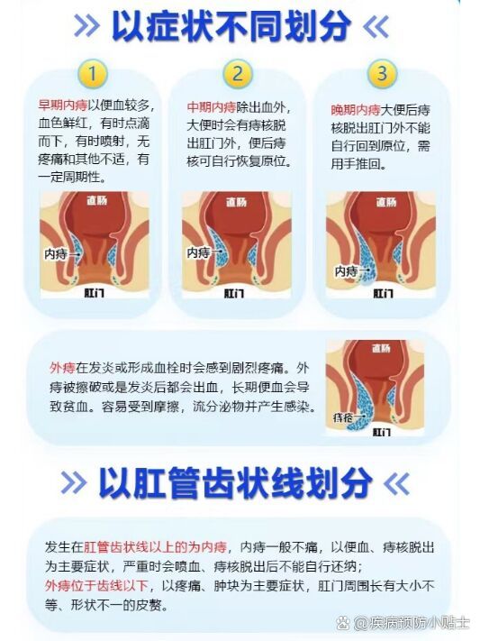 内痔便血能自愈吗