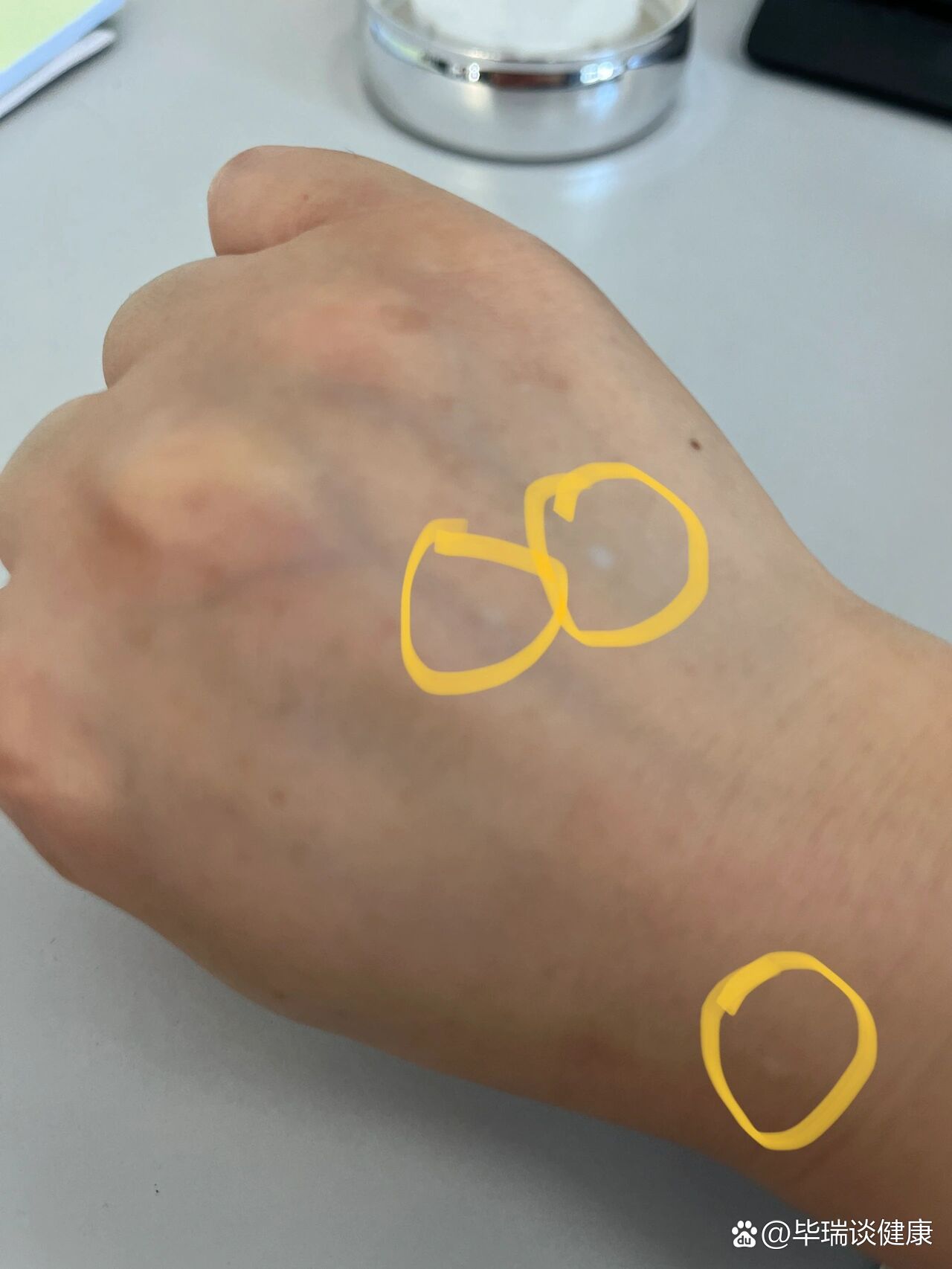 手臂出现小白点怎么办