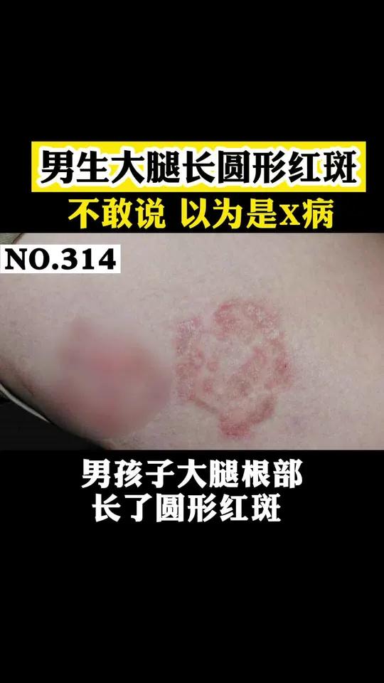 大腿内侧出现一片红斑不痛不痒