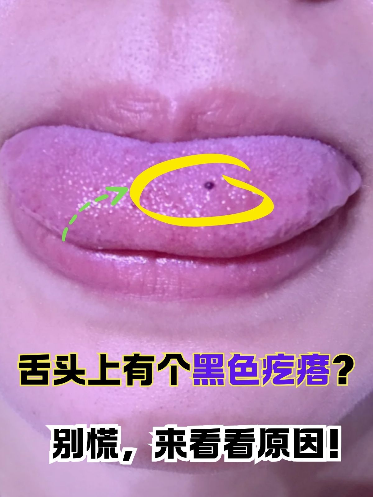舌苔中间发黑事什么原因,怎么办