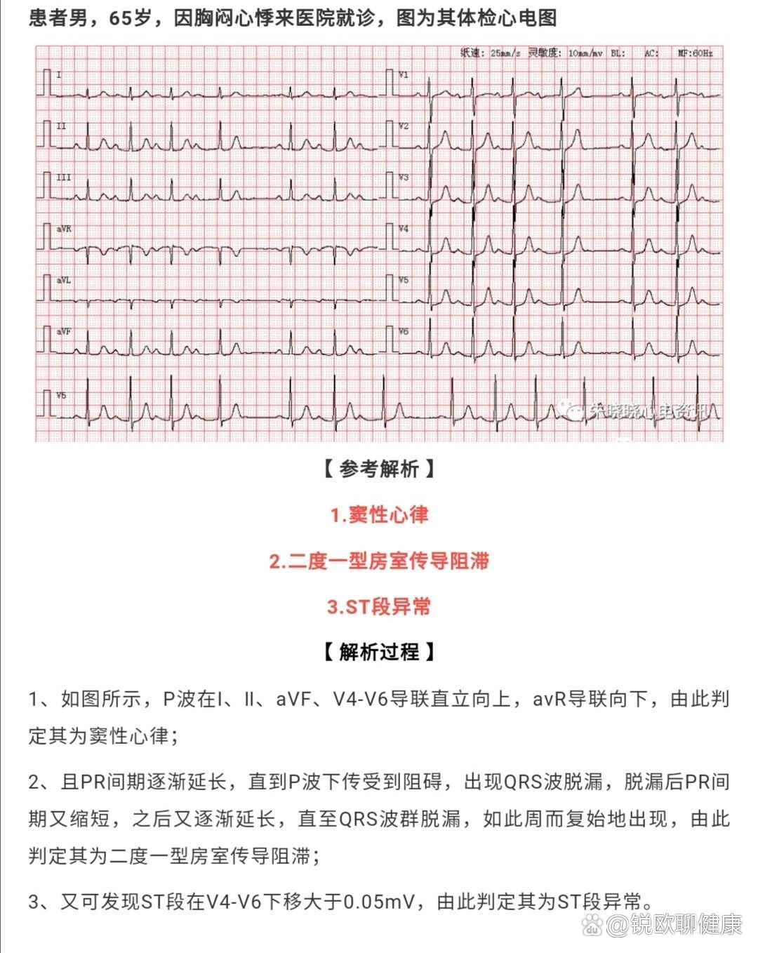 什么叫I度房室传导阻滞?有什么危害?