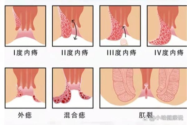 外痔和内痔的区别