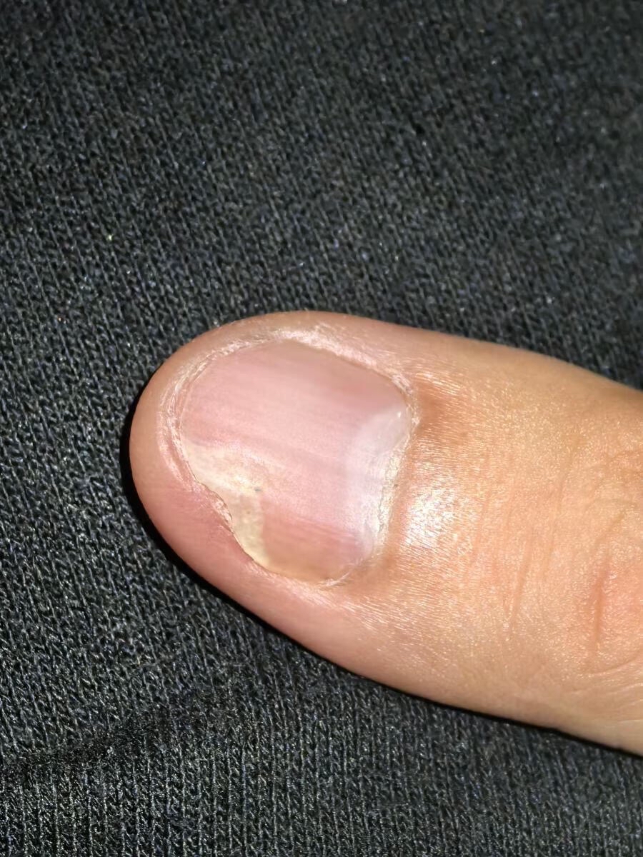 大母指指甲凹凸不平是怎么回事