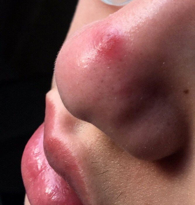 红鼻子什么原因....