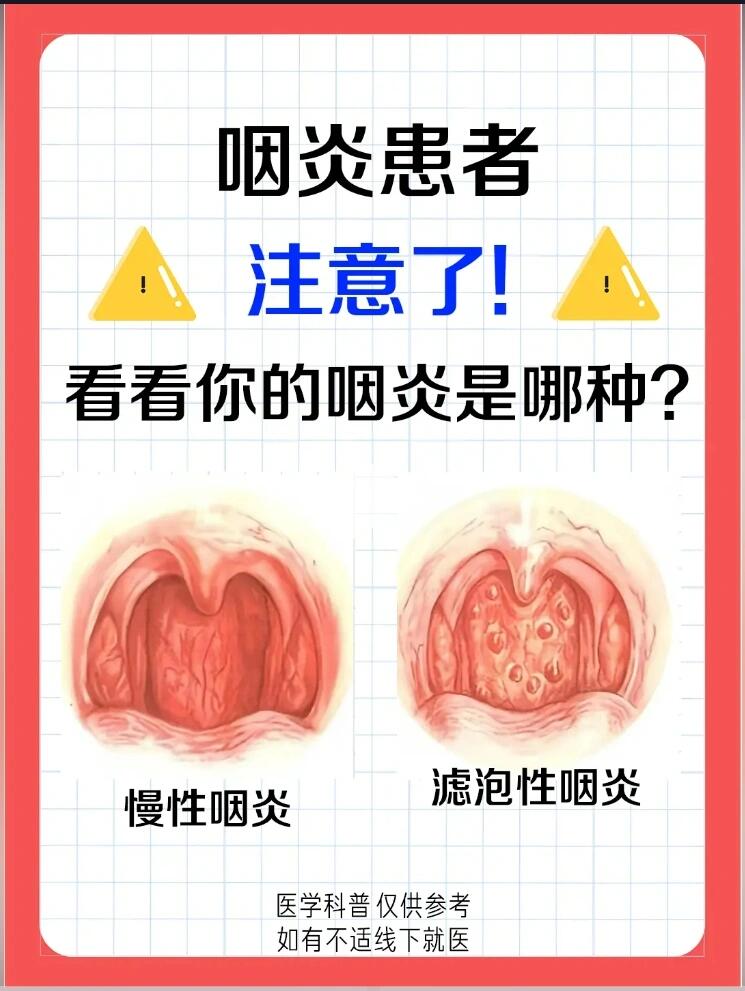 咽喉炎的最佳治疗方法?