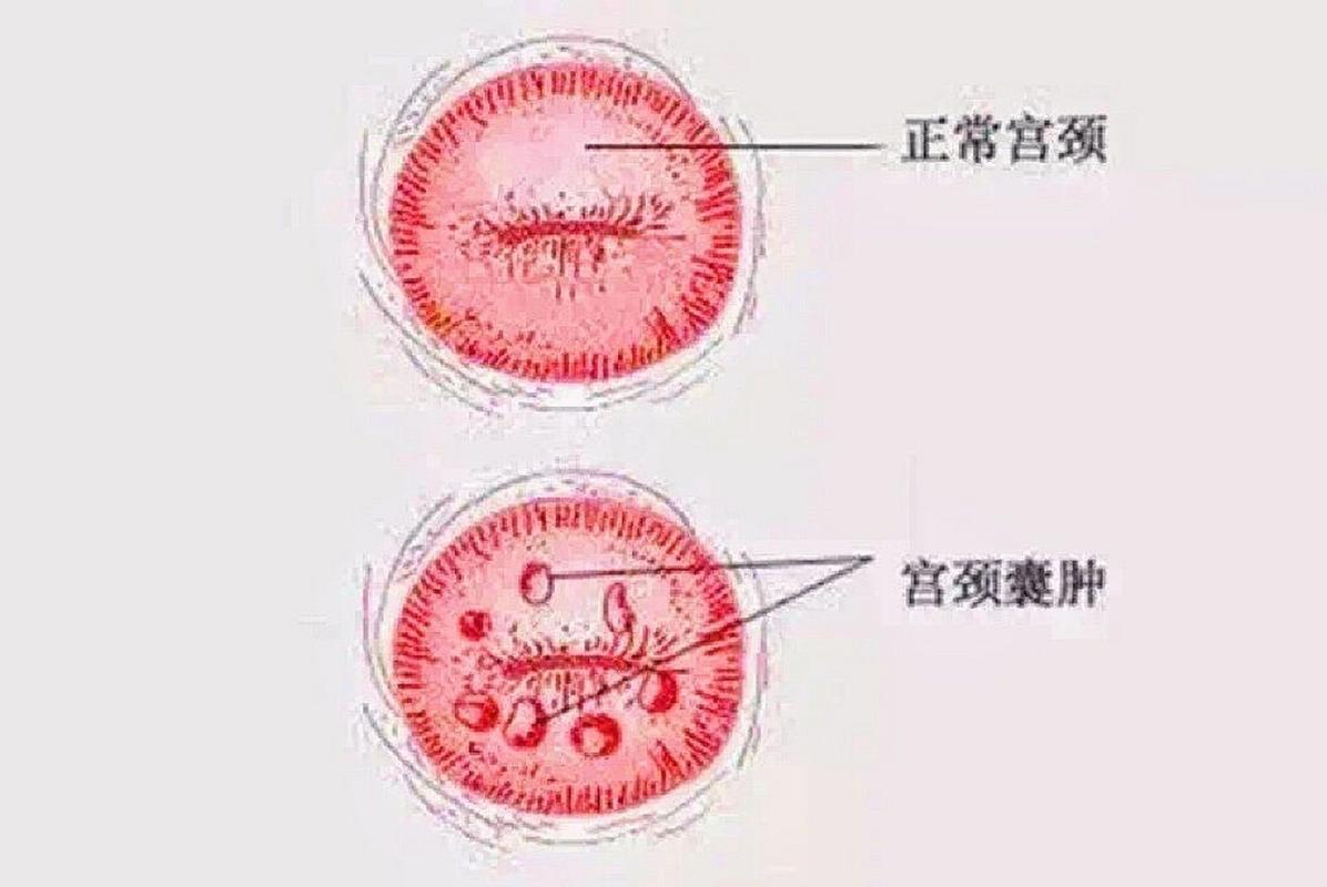 子宫囊肿有什么症状表现
