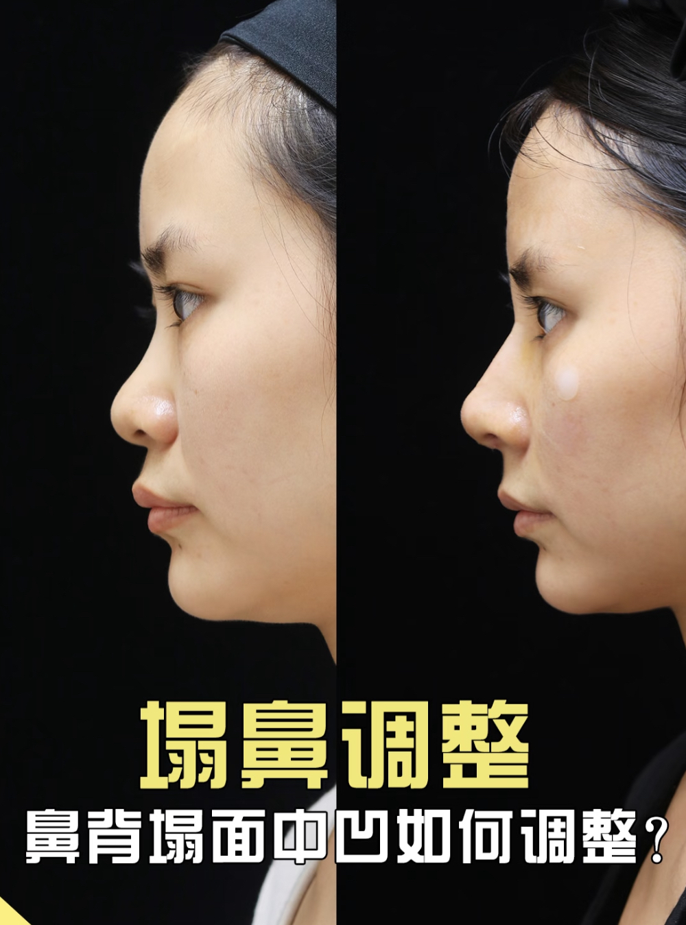 塌鼻梁怎么办?
