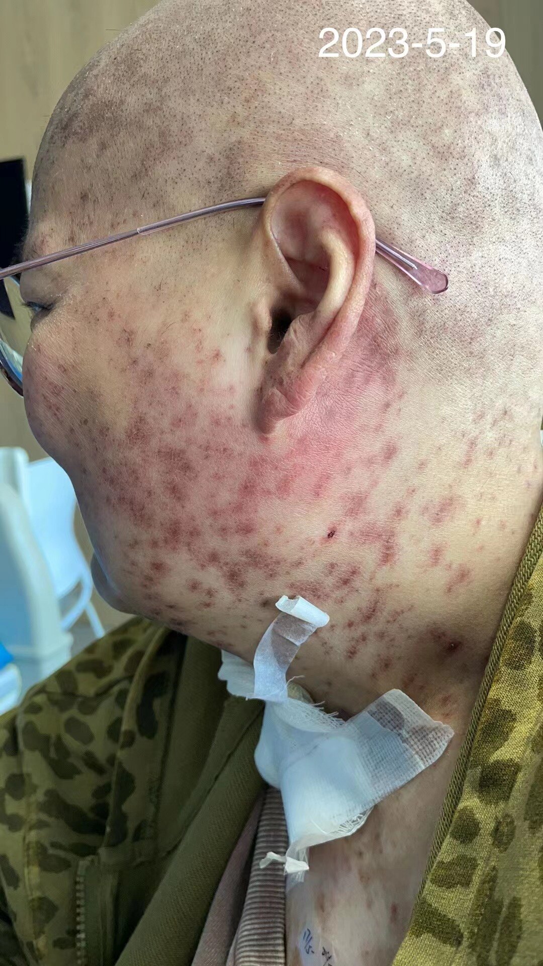 痄腮是一种什么病呢?