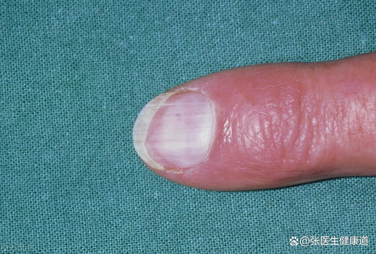 指甲面一棱一棱的怎么回事?