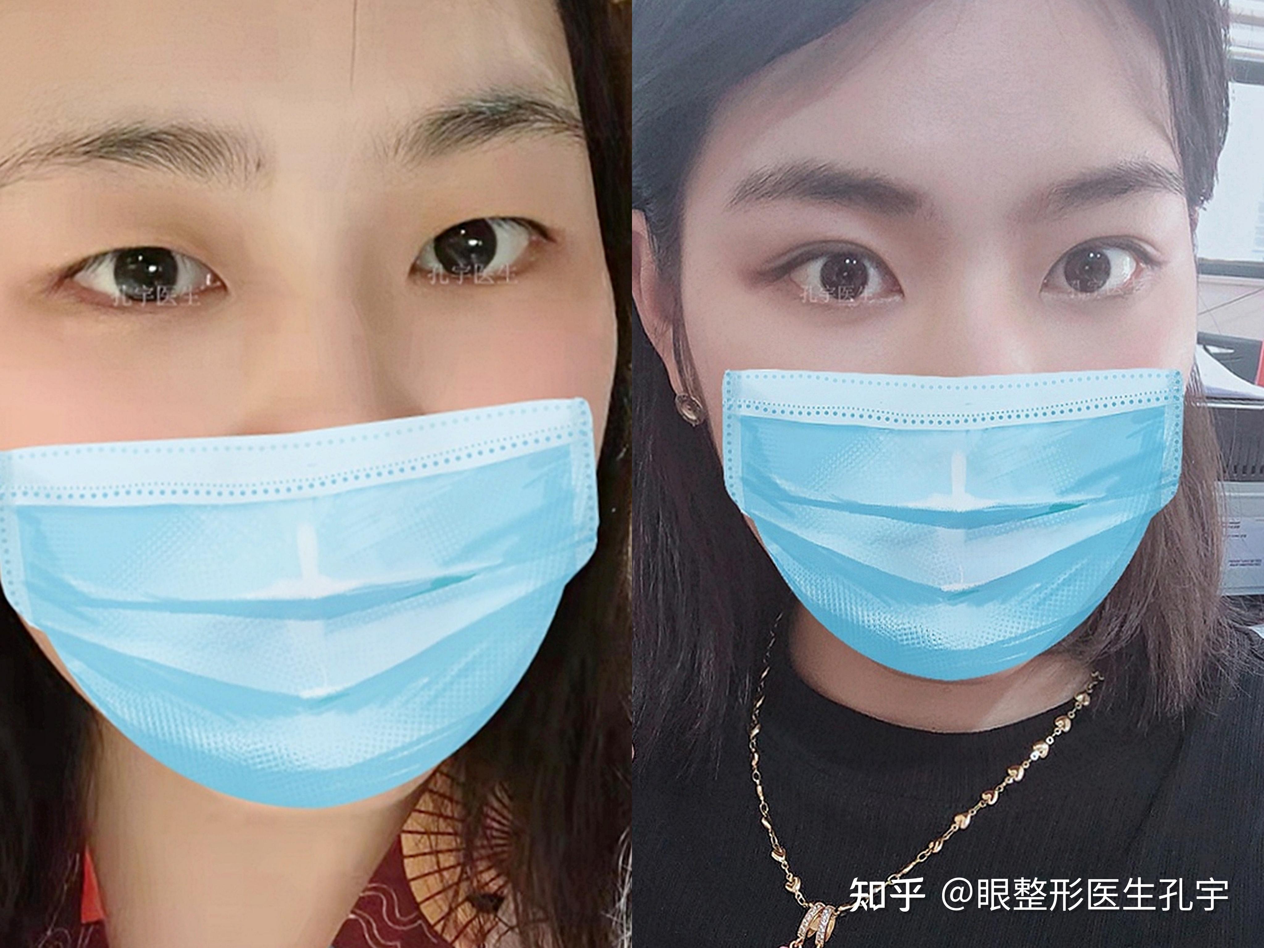 做双眼皮大概多少钱