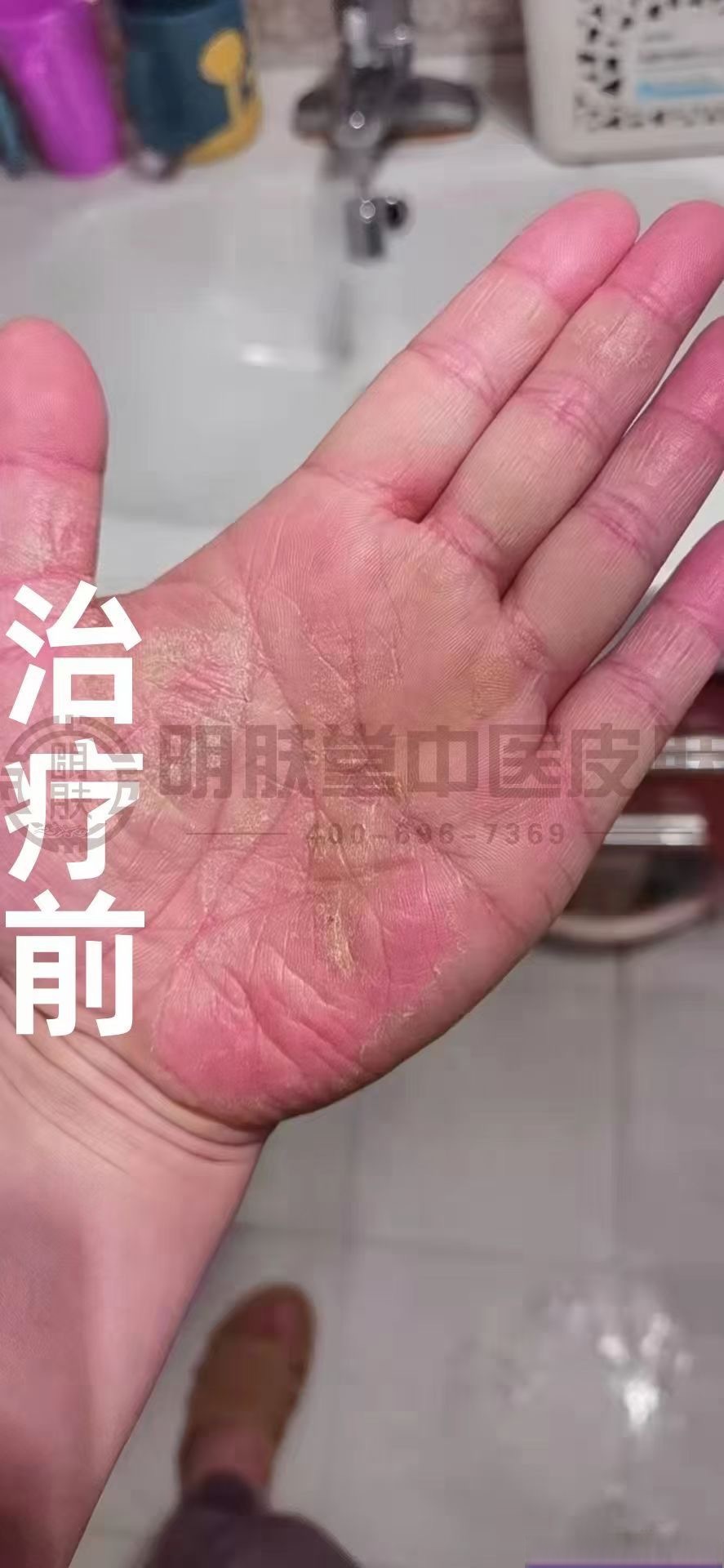 角化型湿疹