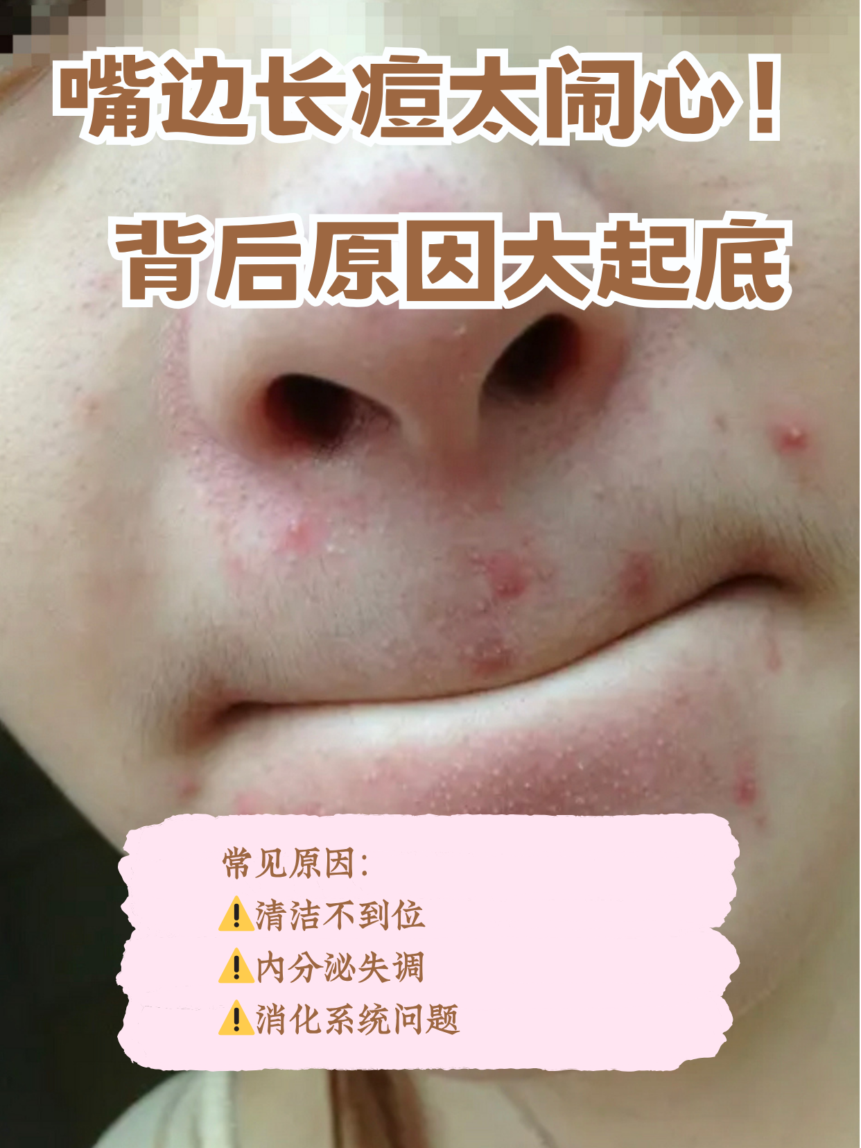 嘴巴周围长痘痘是妇科病吗?