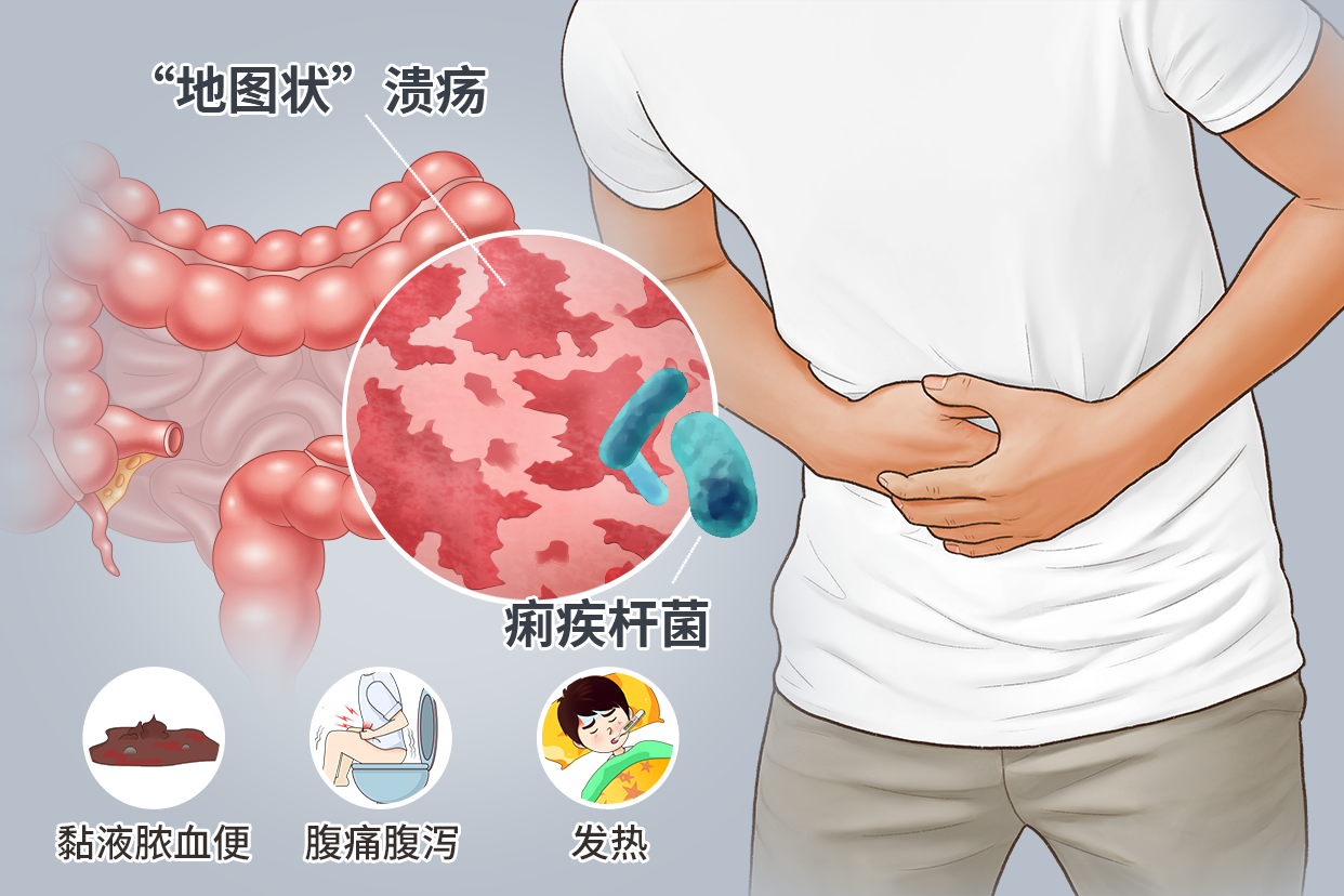 痢疾的发病原因是什么
