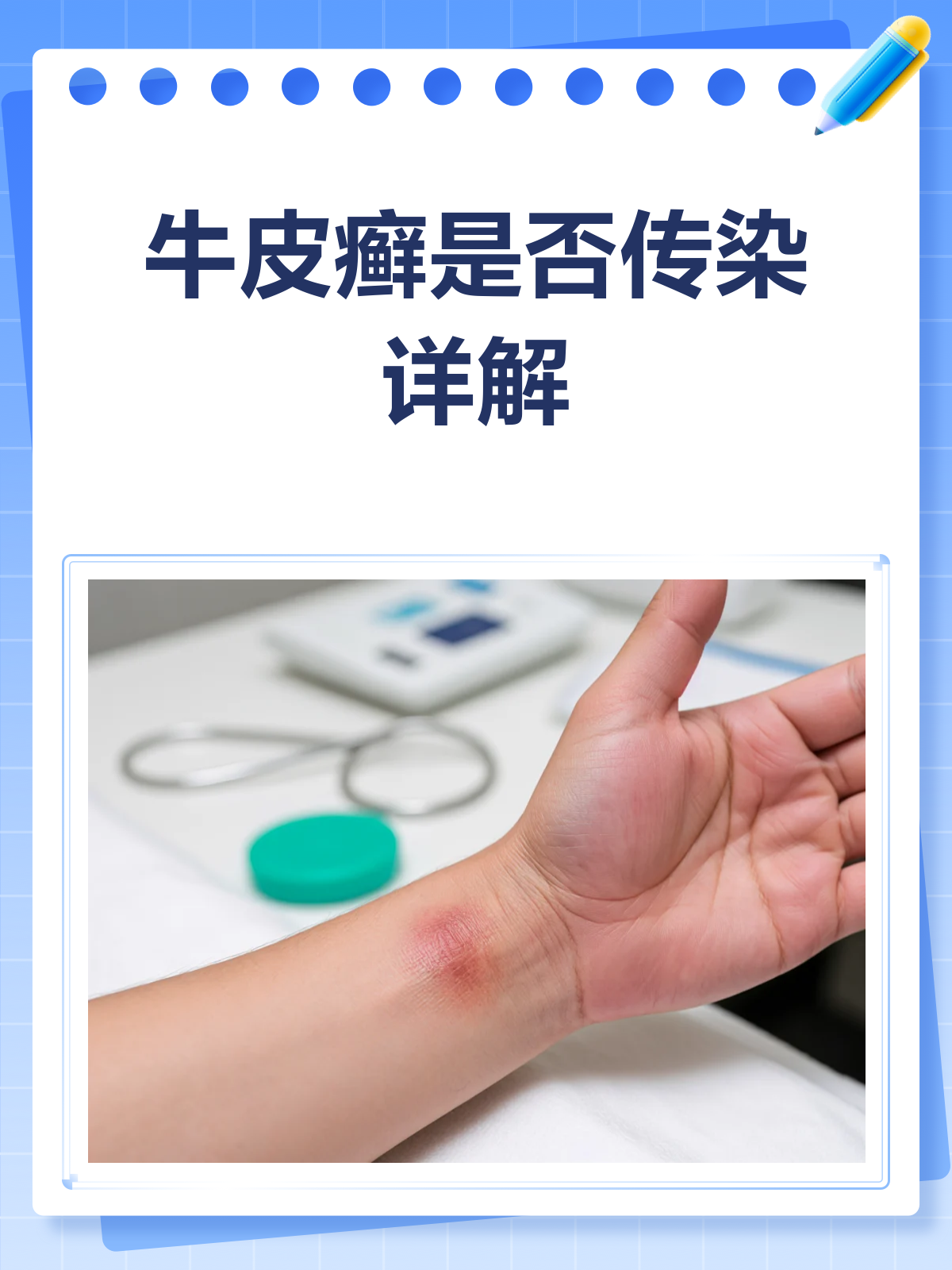 牛皮癣真的不传染吗