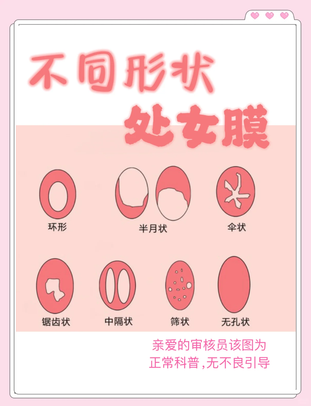 什么是处女膜?