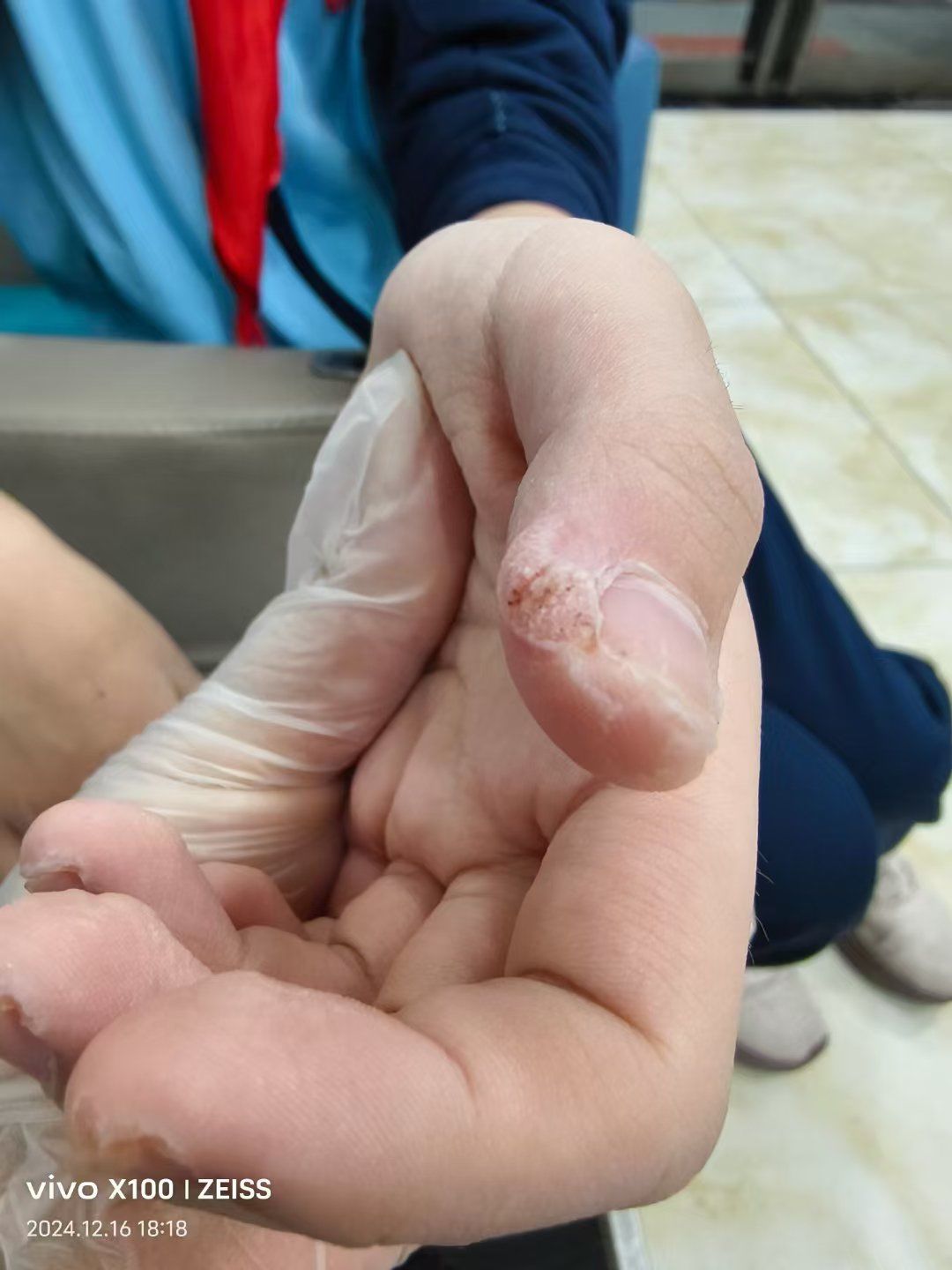 病毒疣治疗方法