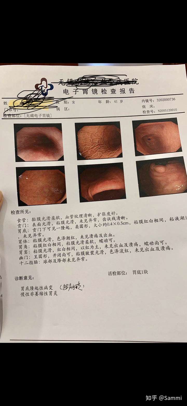 胃肠道间质瘤是什么病
