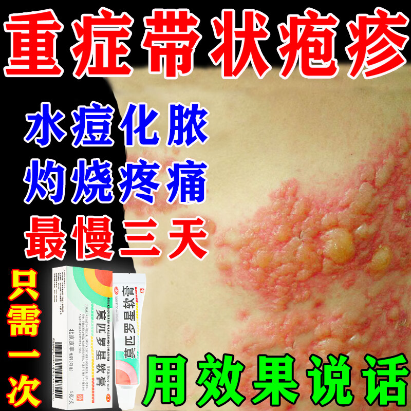 治疗疱疹的药有哪些