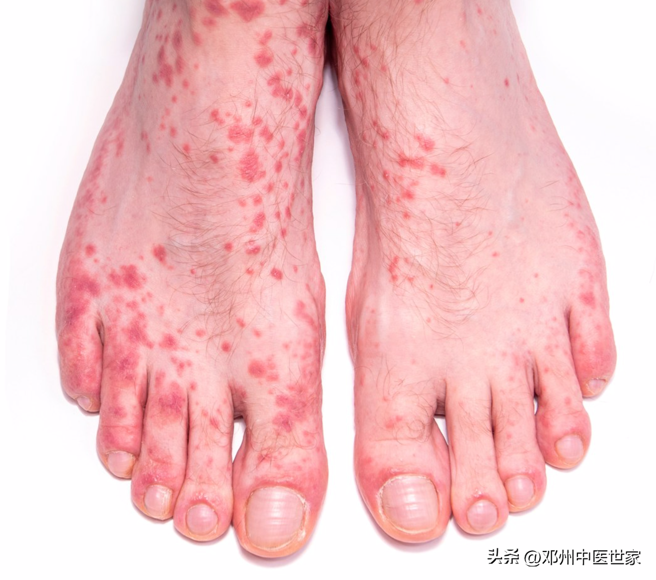 血小板减少会有什么症状