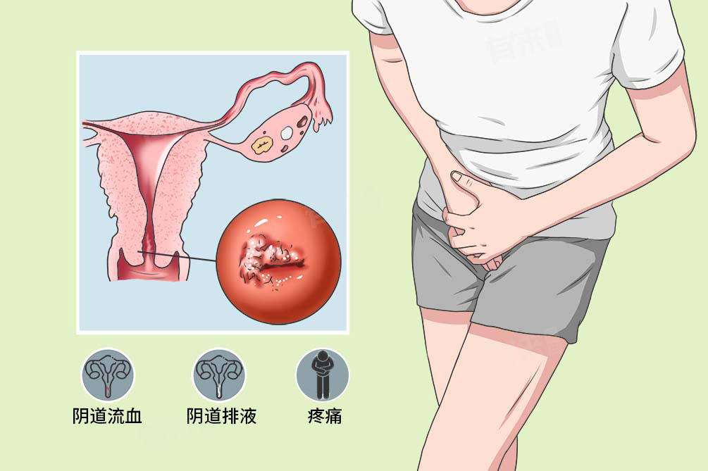宫颈癌晚期临死前有什么症状?