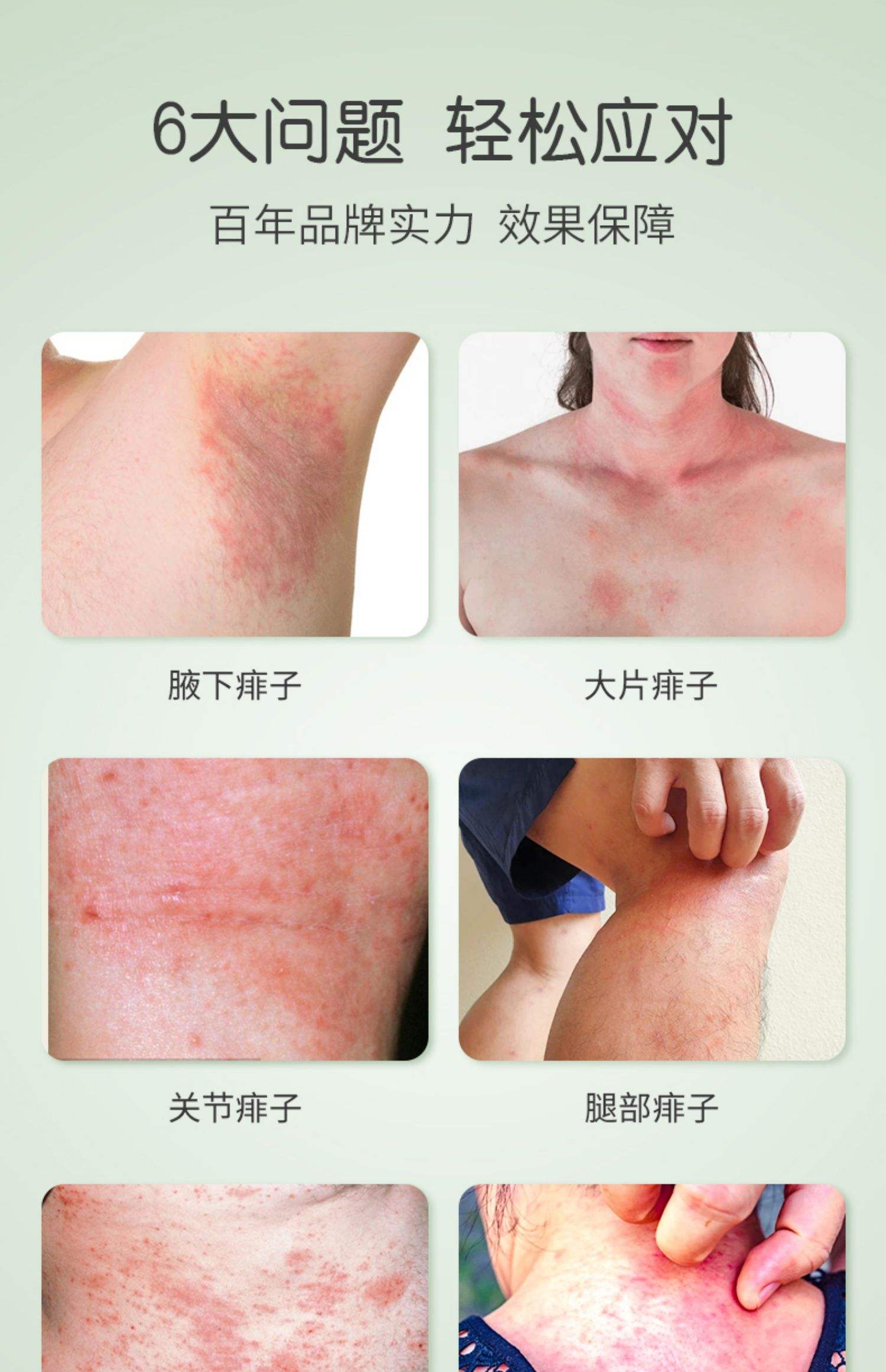 脸上起痱子了该怎么办