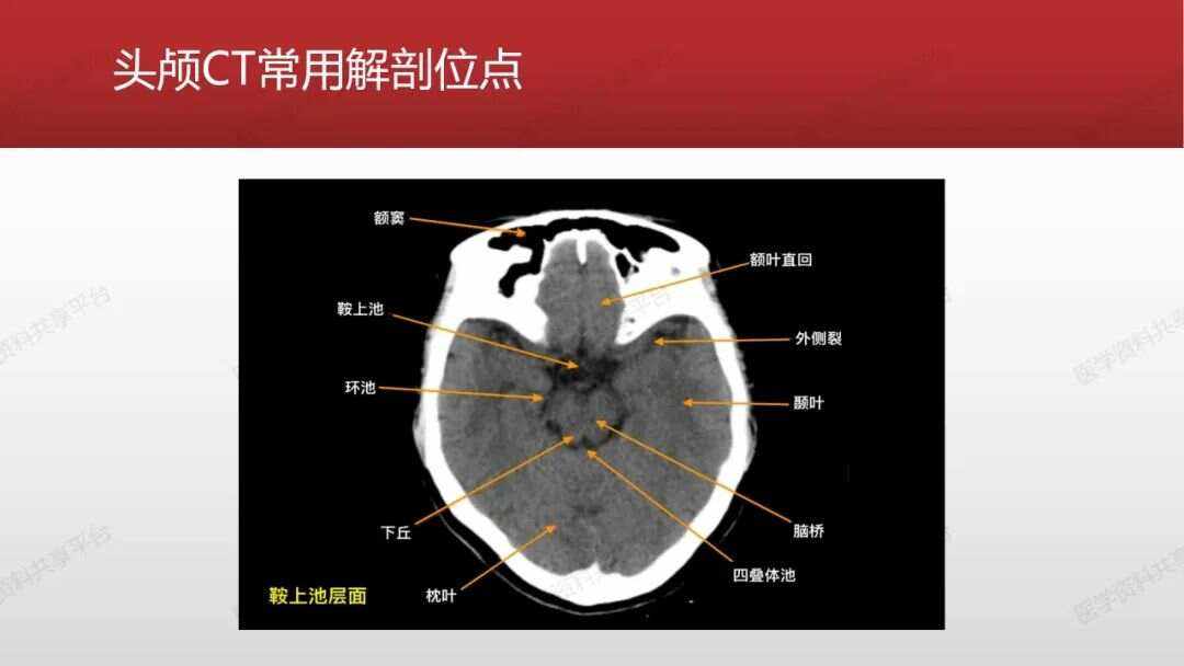 脑CT能查什么病