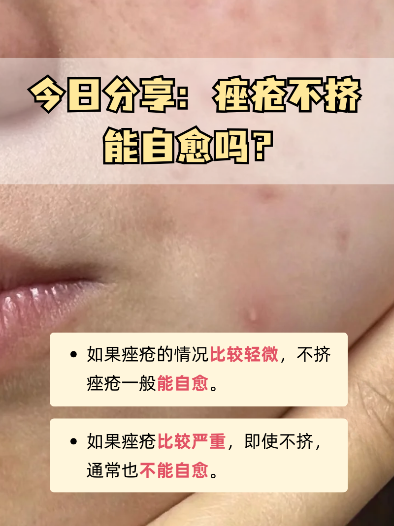 痤疮怎么回事
