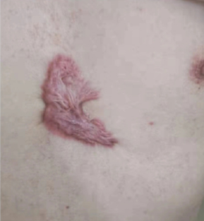 瘢痕疙瘩会癌变吗?