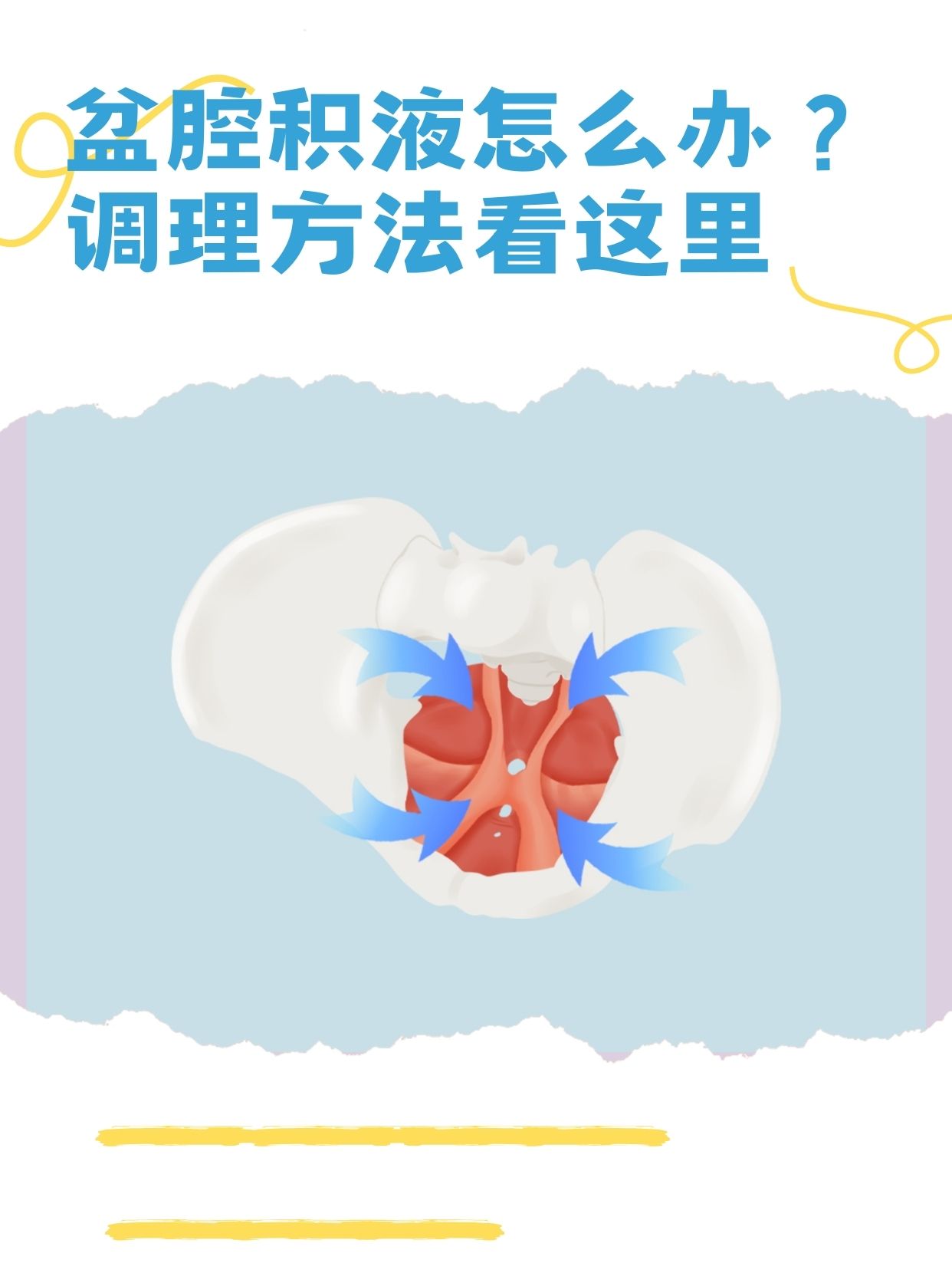 如何消除盆腔积液