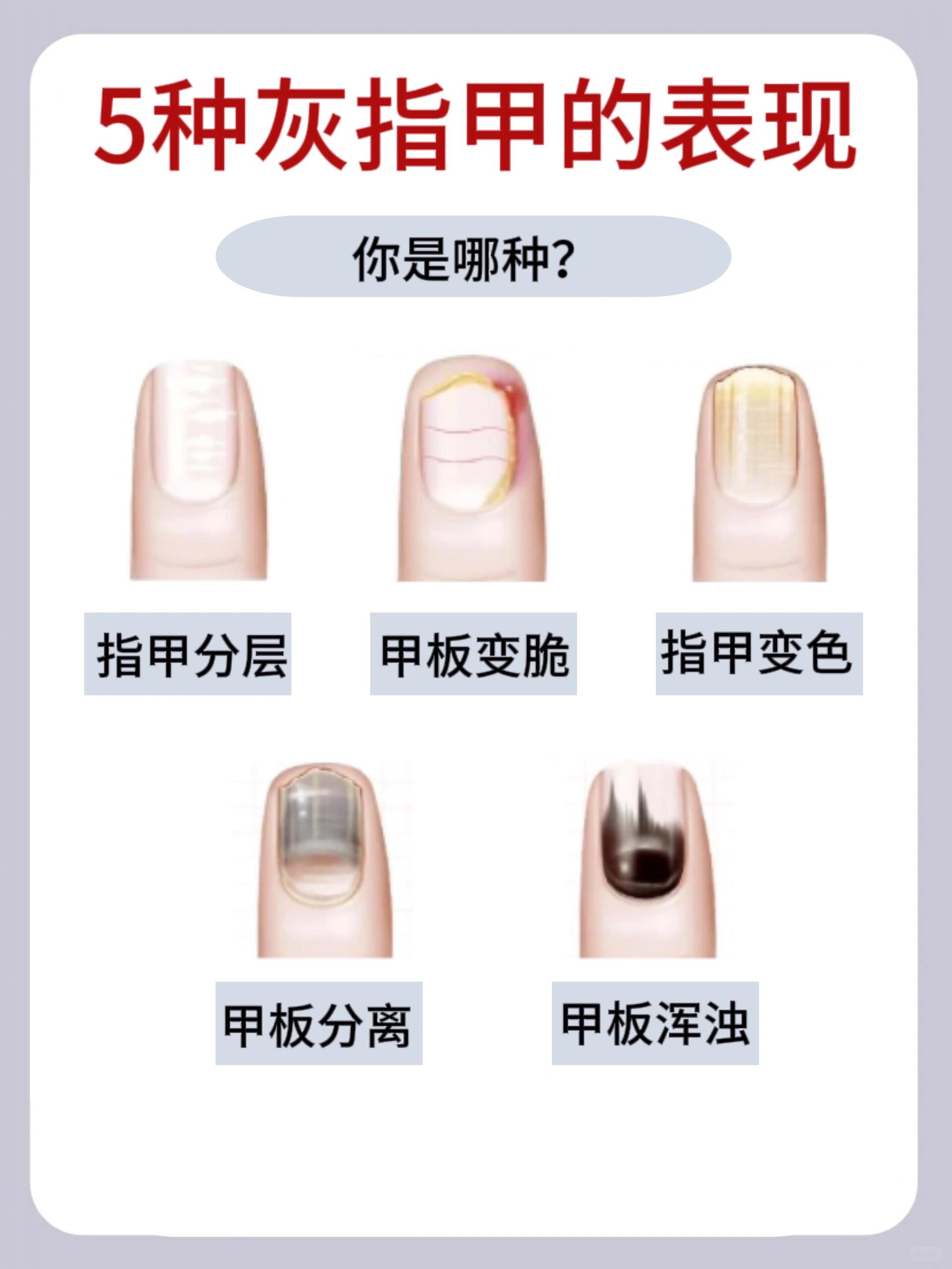 灰指甲会引起哪些危害